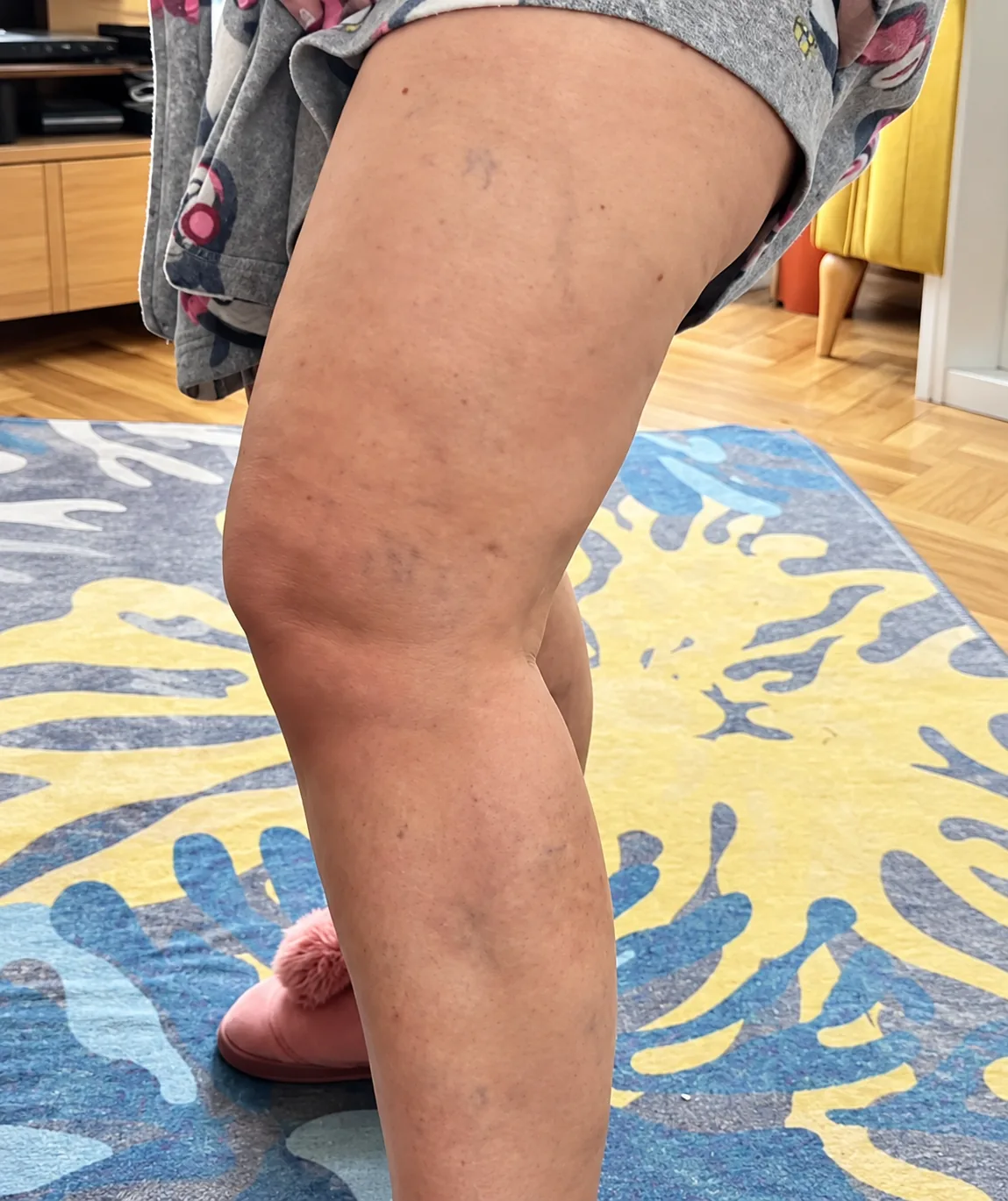 Leg before and after varicose vein treatment after