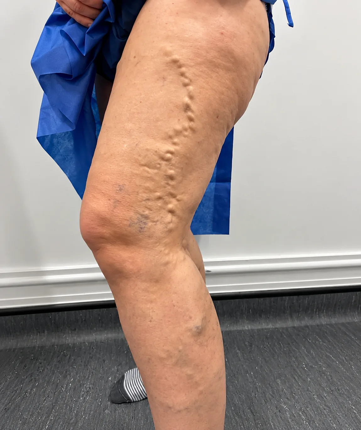 Leg before and after varicose vein treatment before