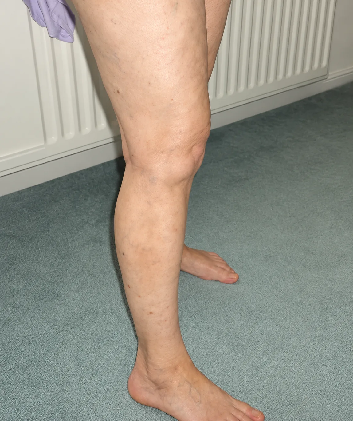 Leg before and after spider vein treatment after