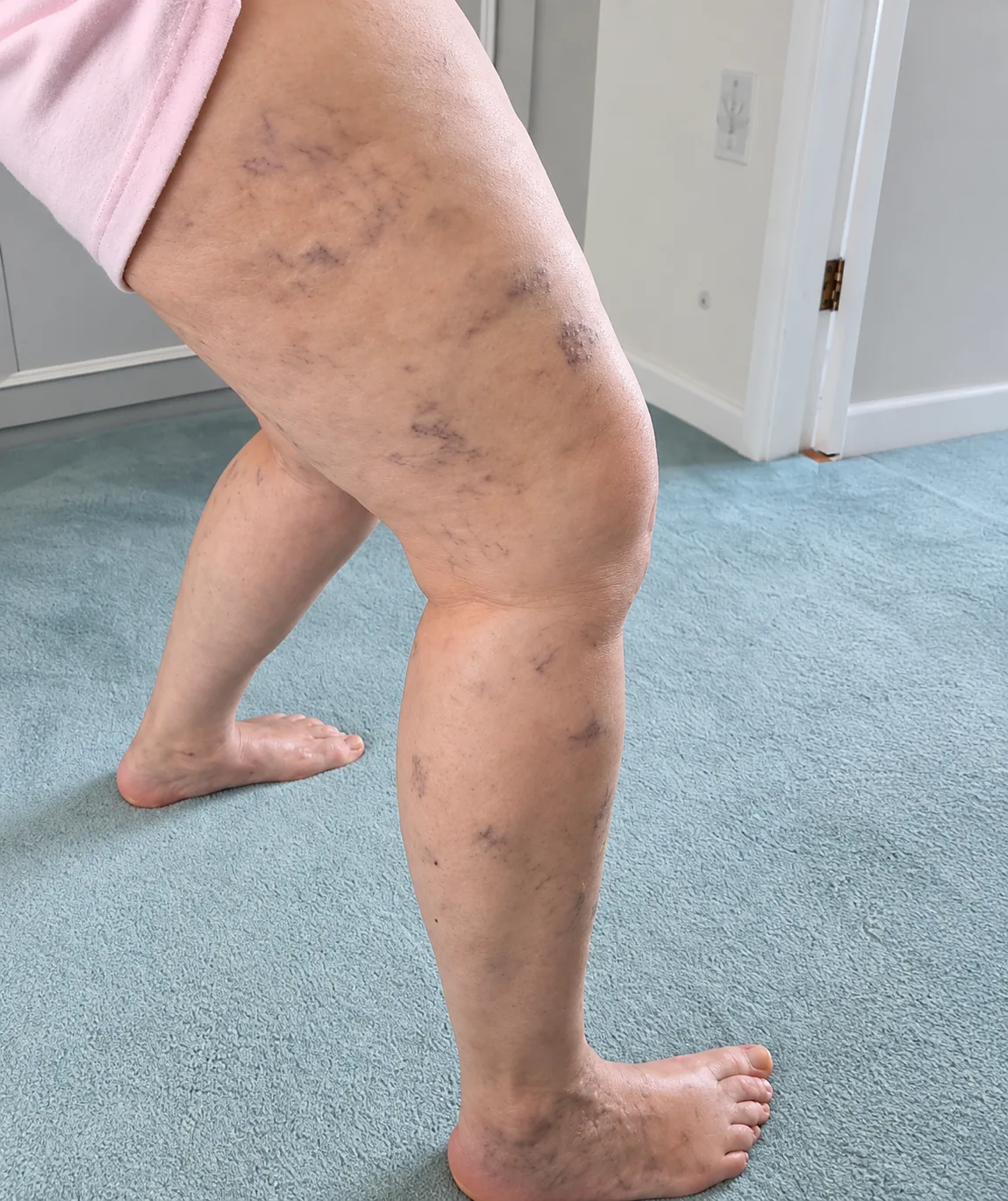 Leg before and after spider vein treatment before