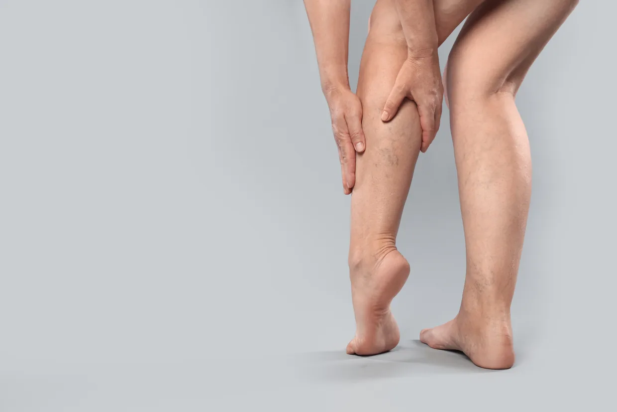 A woman holding her swollen lower leg