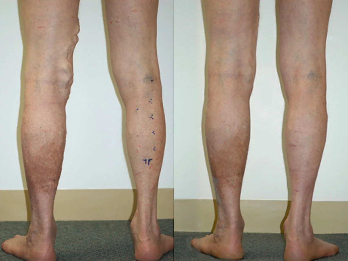 A leg before and after endovenous laser therapy