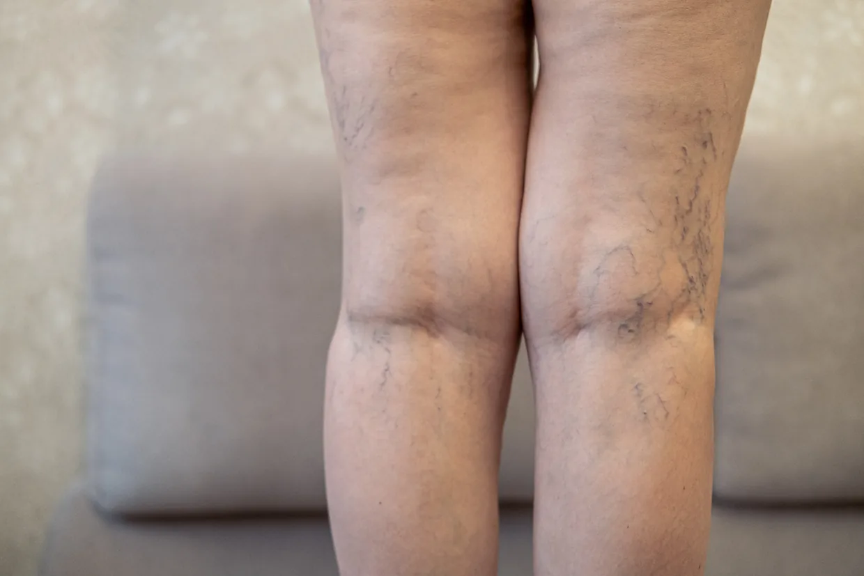 Backs of the knees showing visible varicose veins