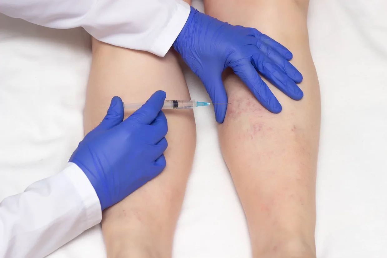 A clinician injecting a varicose vein on a knee