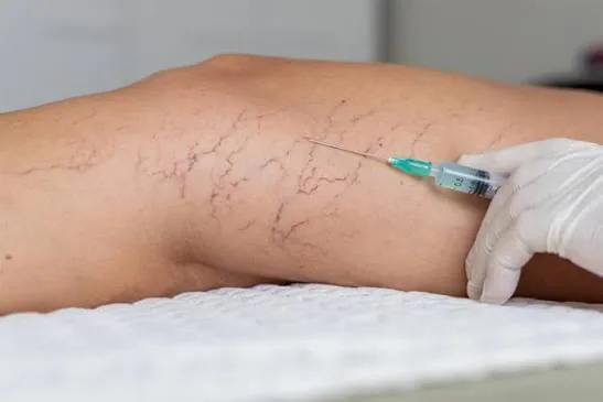 A close-up injection into spider veins on a leg