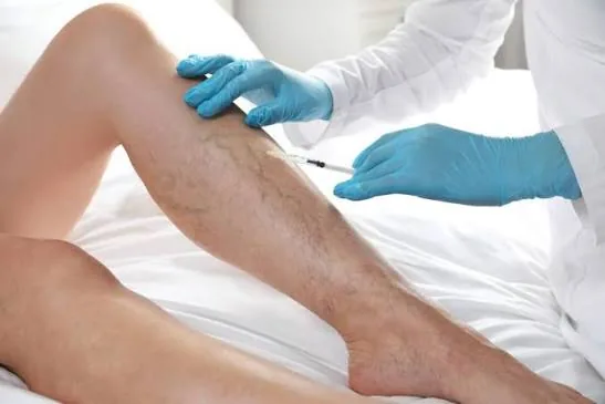 A clinician treating varicose veins on a patient leg