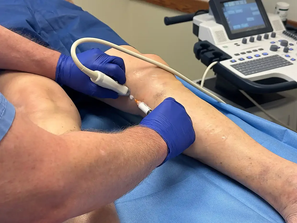 Ultrasound-guided foam injection into a leg vein