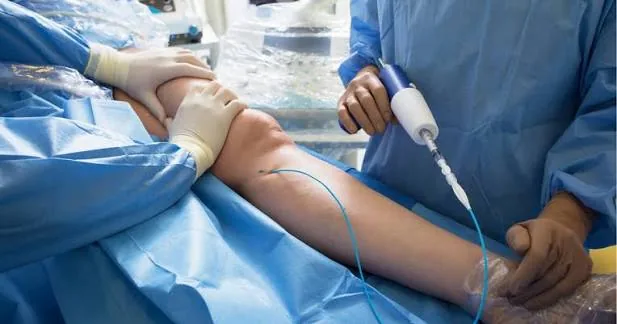 A VenaSeal procedure in progress under sterile drapes