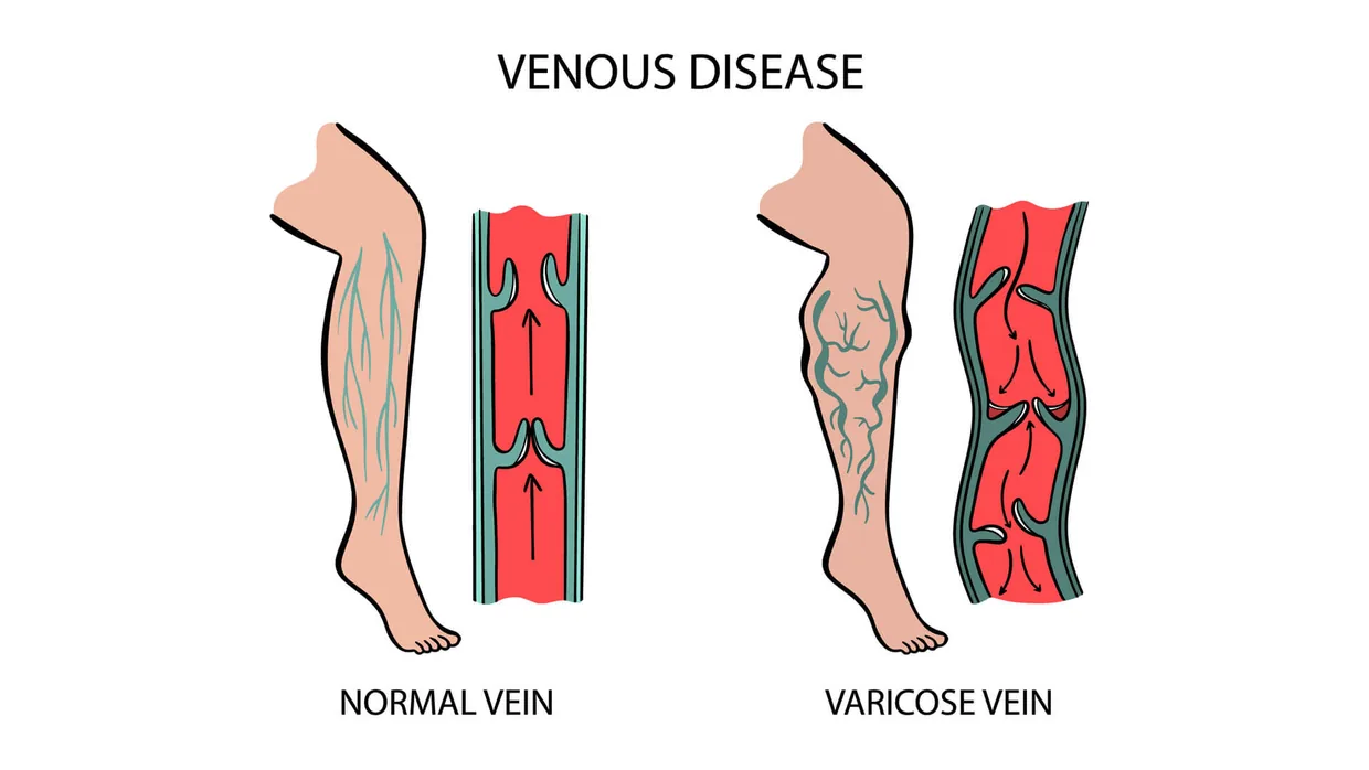 Diagram comparing a normal vein with a varicose vein